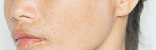 All You Need to Know About Treating Hyperpigmentation: A Skincare Guide